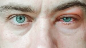 conjunctivitis