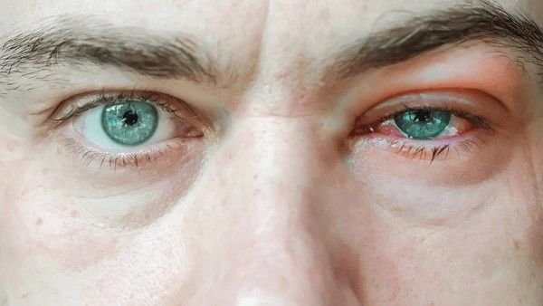 conjunctivitis