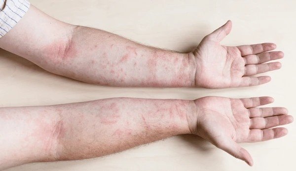 contact dermatitis