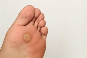 corn on foot