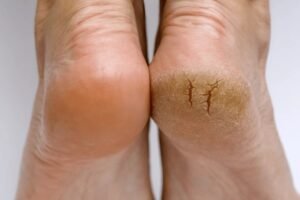 cracked heels