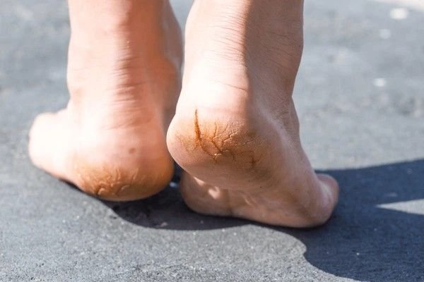 cracked heels in summer