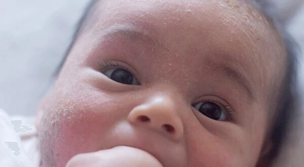 cradle cap