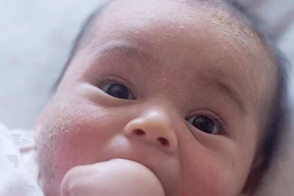 cradle cap