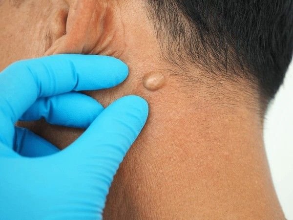 cyst