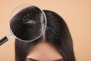 dandruff