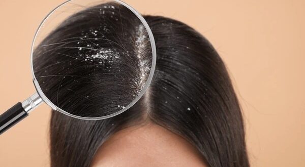 dandruff