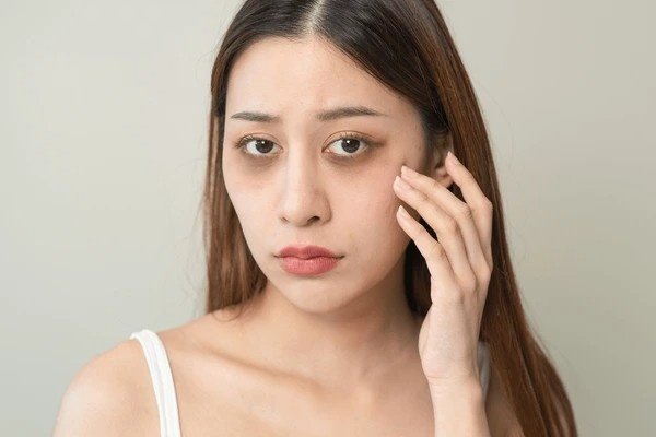 dark circles