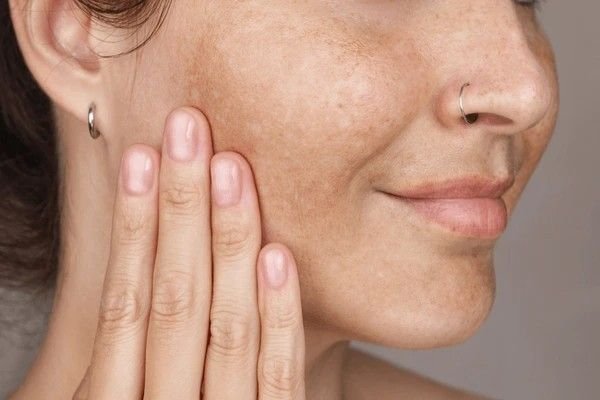 dark spots on face