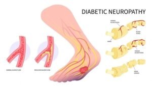 diabetic nerve pain