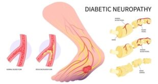 diabetic nerve pain