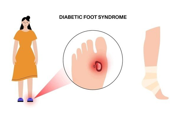 diabetic wounds