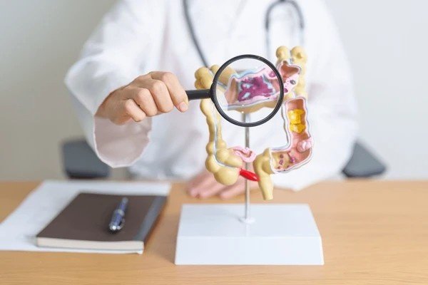 diverticulitis