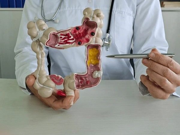 diverticulitis