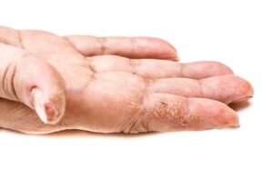 dry cracked hands and fingers