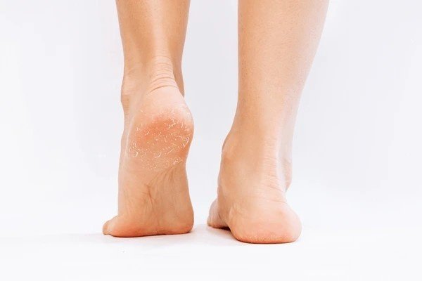 পায়ের শুষ্কতা (Dry Feet) দূর করার ঘরোয়া চিকিৎসা – Nobonirman Patrika
