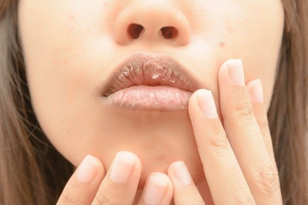 dry mouth