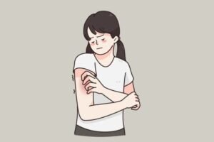 eczema