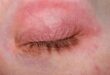 eczema on eyelids