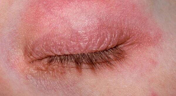 eczema on eyelids