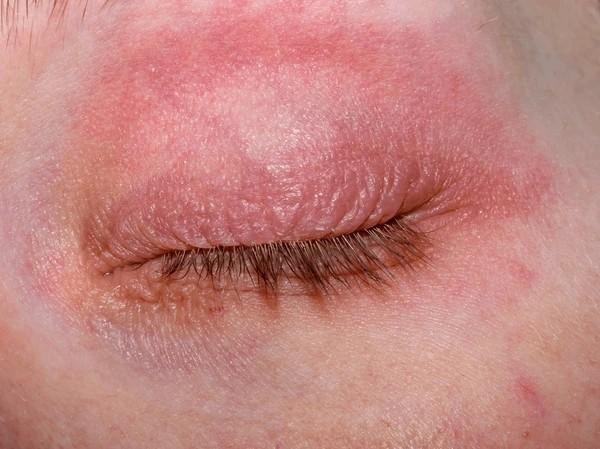 eczema on eyelids