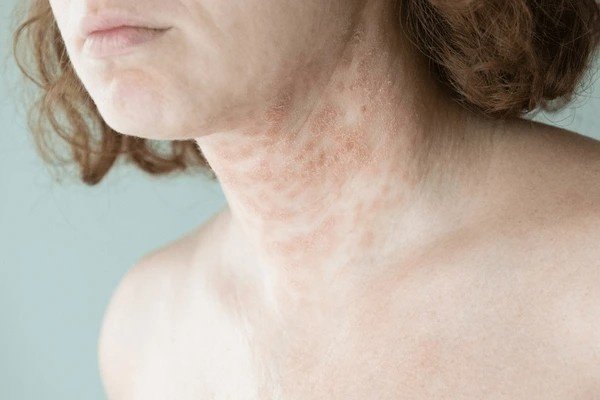 eczema scars