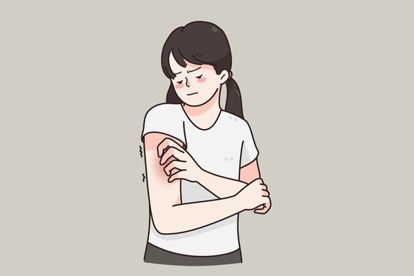 eczema