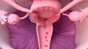 endometriosis