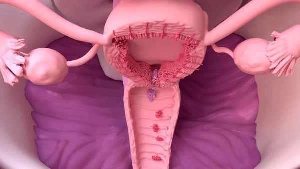 endometriosis