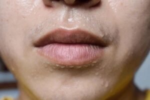 excessive sweating on face