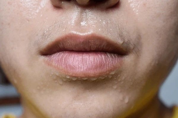 excessive sweating on face