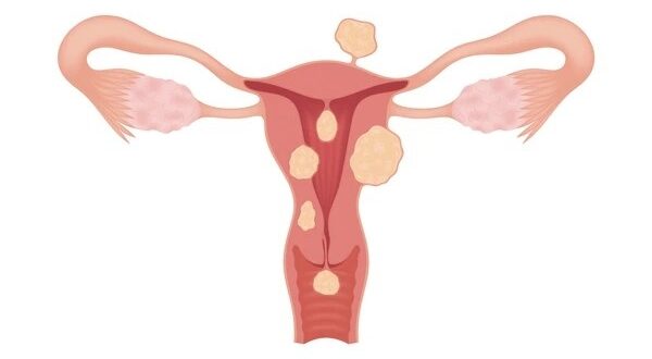 fibroid without surgery