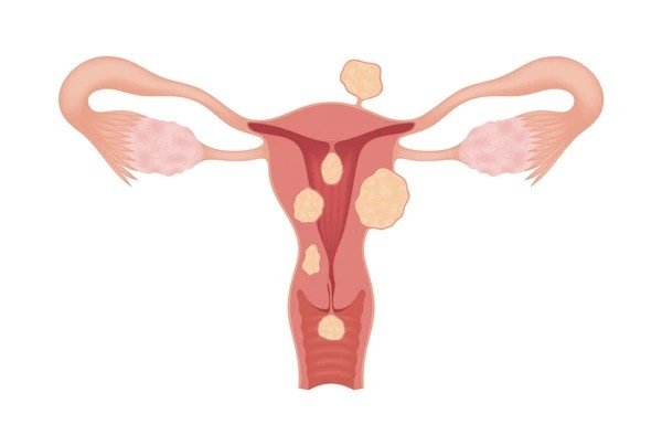 fibroid without surgery