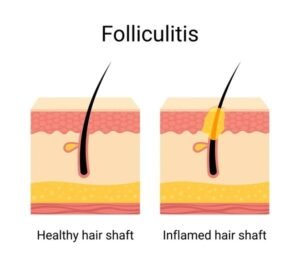 folliculitis