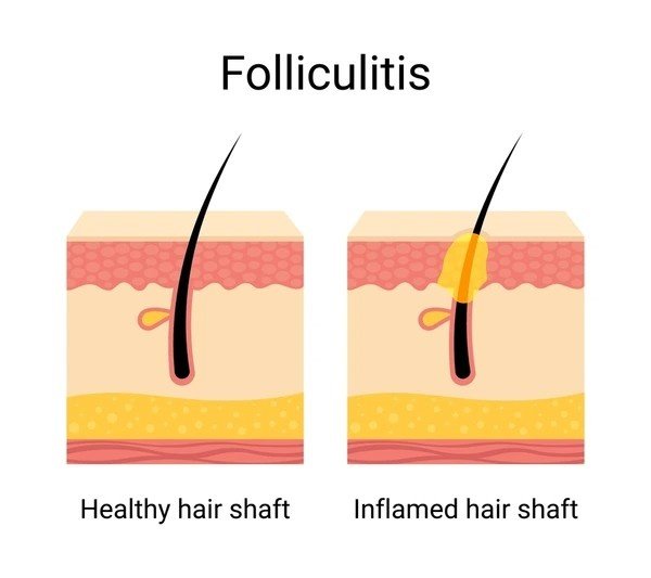folliculitis