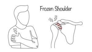 frozen shoulder