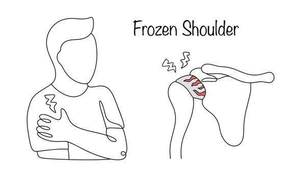 frozen shoulder