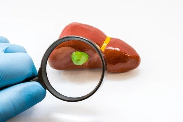 gallstone flushing