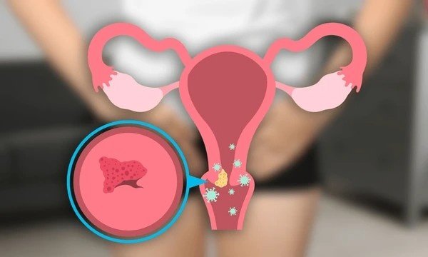 genital warts
