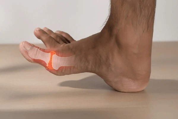 gout baking soda