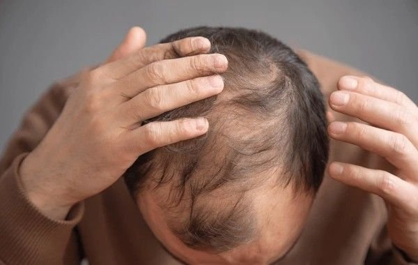 hair loss