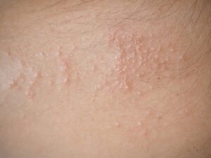 heat rash