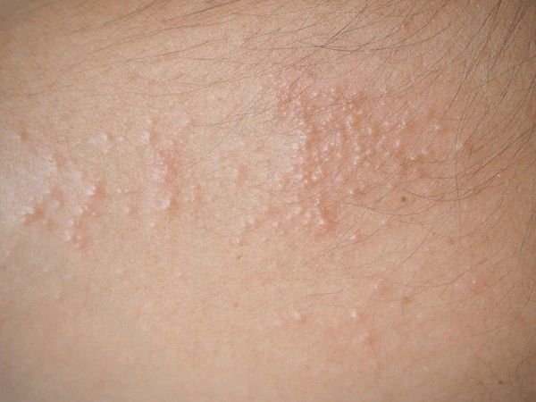 heat rash