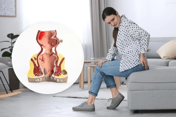 hemorrhoids women