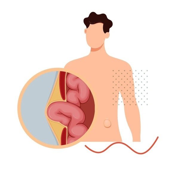 hernia