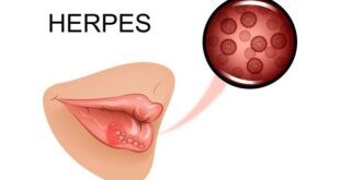 herpes