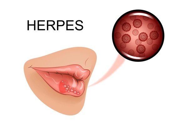 herpes