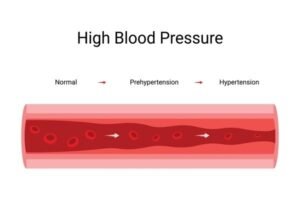 high blood pressure (2)