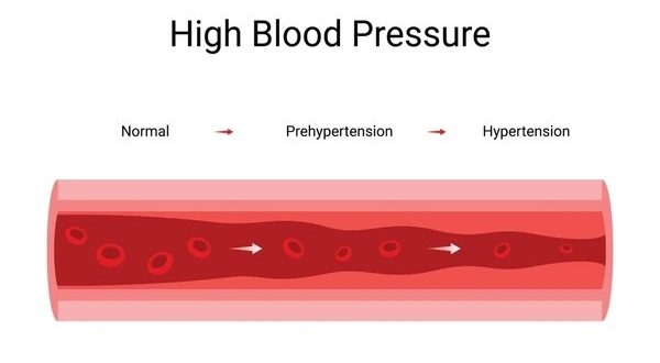 high blood pressure (2)