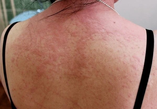 hives